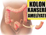 Kolon Kanseri Ameliyatı Oyna