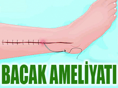 Bacak Ameliyatı